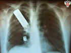 Осколок гранаты вытащили донецкие врачи из груди пациента: операцию проводили в бронежилетах и касках