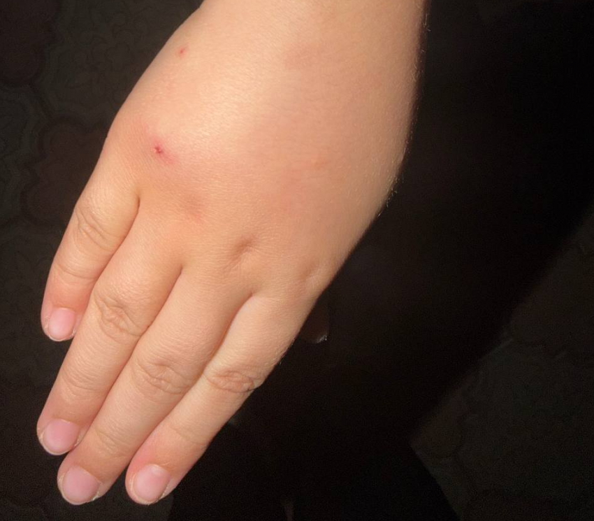  В донецком ресторане собака укусила 6-летнего ребёнка прямо на веранде
