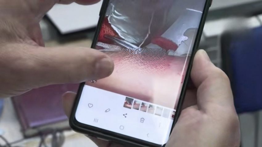 Укус комара в Краснодаре оставил 15-сантиметрового червя в теле девочки из Мариуполя